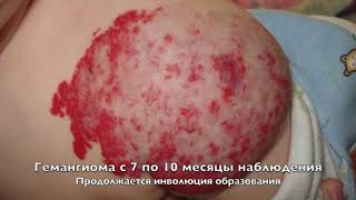 Гемангиома. Естественное течение