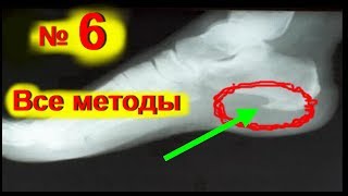Пяточная шпора лечение в домашних условиях! Как лечить шпору- боль в пятке - № 6 | #edblack