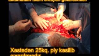 abdominoplastika  XEZER KLINIKASI Dr.Cərrah İlqar Yusubov