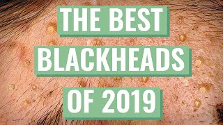 Mr.Blackhead’s Best Extractions for 2019 Compilation + Q&A