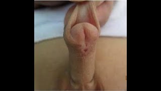 Hypospadias repair by Dr Ramesh Babu, Pediatric Urologist, Sri Ramachandra Hospital Chennai