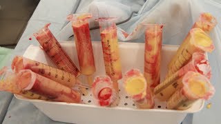 Удаление геля из груди (молочных желез)