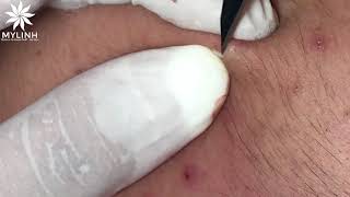 CLEAN ACNE POPPING #2 [0934000075]