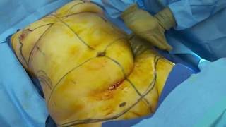 Abdominoplasty - Tummy Tuck in Baltimore MD | Michele Shermak MD
