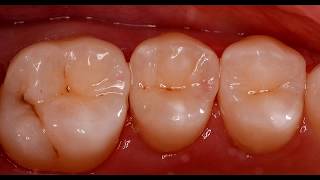 Кариес под микроскопом 2017 \ caries treatment under microscope