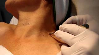 FIBROMAS LAXOS RESECCION