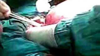 cirugia de fibroma de utero