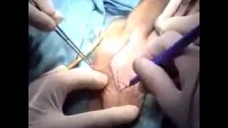 Sex Change Surgery~ Male to Female (MtF)