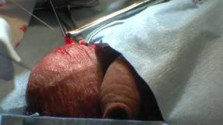 Vasectomy, Warkworth New Zealand