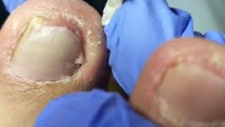 High tech pull out Ingrown Toenail，轻微甲沟炎，拔出嵌甲真的超爽，走路一点也不疼了！ 68