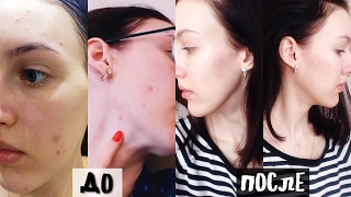 КАК ИЗБАВИТЬСЯ ОТ АКНЕ? УХОД ЗА ЛИЦОМ и моя история