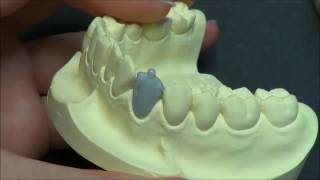 Моделирование нижнего клыка (Live wax up  Lower canine)