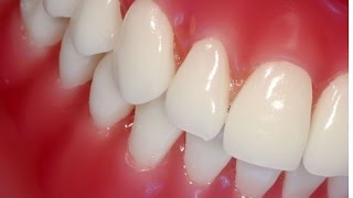 Копеечное Народное лечение десен - как укрепить десна и зубы -рецепт № 7
