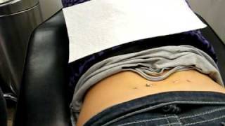 Surface Lowerback Piercing.