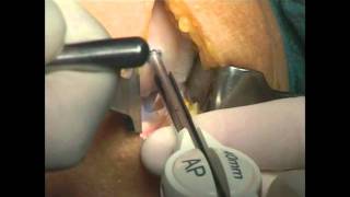 UniCAP knee resurfacing performed by Dr Sandro Giannini Bologna, ITALY