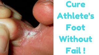 How To Get Rid Of Foot Fungus or Athlete’s Foot Naturally || Cure Tiena Pedis Naturally
