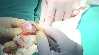Penile Implant via pure Local Anesthesia I (Sep. 20th, 2017)