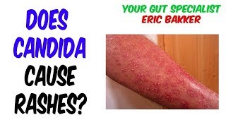 Can a Candida Cleanse Cause a Skin Rash?