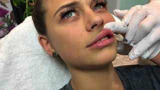 Lippenaugmentation