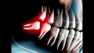 Wisdom teeth removal! Удаление зуба мудрости!