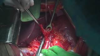 Open D2 Total Gastrectomy