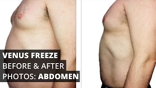 Venus Freeze™ Before & After Photos: Abdomen