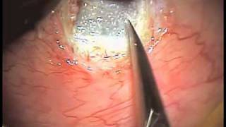 Esclerectomia Profunda Não Penetrante - NON PENETRATING DEEP SCLERECTOMY