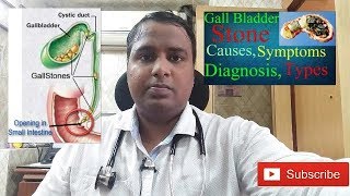 gallbladder stones treatment(पित्त की थैली में पथरी का इलाज)