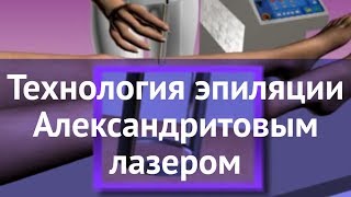 Технология эпиляции Александритовым лазером