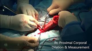 Subcoronal IPP with modified Wilson's Deaver maneuver