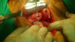 BICORNUATE UTERUS DOUBLE UTERUS TREATMENT BY DR G S S MOHAPATRA