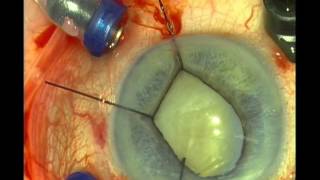 20.5 Extraction of dropped nucleus with ICCE and retropupillar Verisyse IOL.