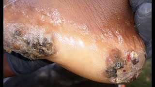 Victor's Many jiggers and feet deformed by them (3 of 4)