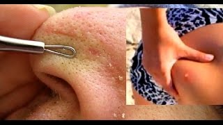 Выдавливание прыщей, угрей - профессиональный инструмент с КИТАЯ