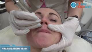 Алмазная шлифовка микродермабразия пилинг в Одессе клиники Estetic Medical