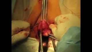 Fast vaginal hysterectomy procedure-$3,000 in Greece