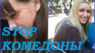 Комедоны закрытые \ Милиумы \ Белые угри \ Просянки. Как удалить. Кислотный пилинг дома