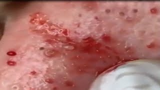 Best Blackheads Remover #30, การดูแลรักษาผิว