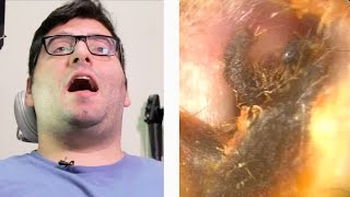 People Get Earwax Extractions For The First Time