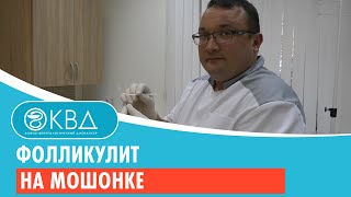 Фолликулит на мошонке. Клинический случай №11