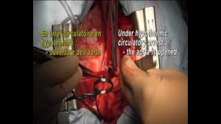Dissection aortique aiguë type A / Acute type A aortic dissection repair