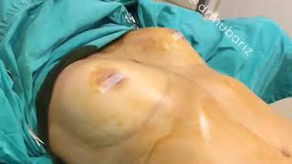Sinə Böyütmə damla implantı ilə