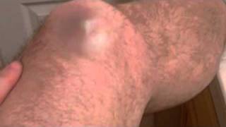 Huge Zit on leg!