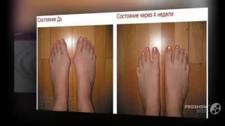выступает косточка на ноге

  - Valgus pro купить