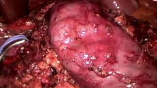 Pancreatic cancer - Michael Kendrick
