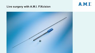 Live surgery with A.M.I. FiXcision