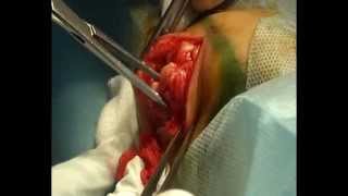 Иссечение околоктевой бурсы.\Excision of ulnar bursa