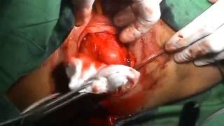 Colpocleisis: LeFort Procedure