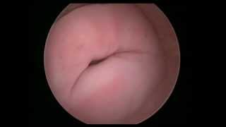 sad cervix