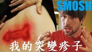 Smosh：我的突變疹子 My Mutant Rash!【中文字幕】